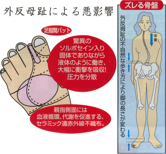 ソルボ 外反母趾