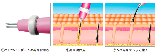 プラソニエ スタイルエピ100桜pd221 ベターライフ正規品 高周波脱毛器 2個 送料無料 の通販