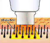 フラッシュ脱毛の仕組み